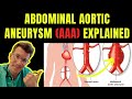 Doctor explains ABDOMINAL AORTIC ANEURYSM (AAA) | Symptoms, risk factors, treatment, screening.