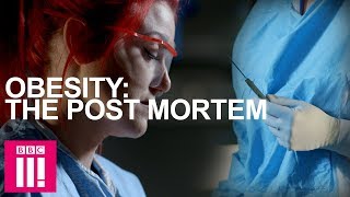 Autopsy On An Obese Woman: Obesity Post-Mortem