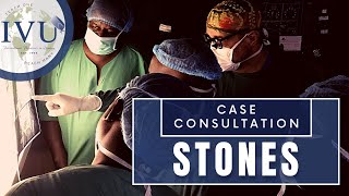 IVUmed VVP Case Consultation: Stones