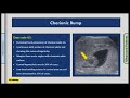 ultrasound pearls chorionic bump