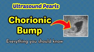 Ultrasound Pearls: Chorionic Bump