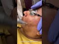 pico laser treatment for melasma live