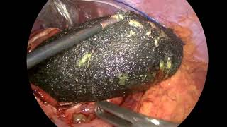 Laparoscopic removal of trichobezoar (Rapunzel syndrome)