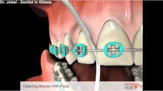 Cleaning Braces With Floss - Dentist Ottawa