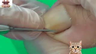 👣SUPER DEEP and HUGE INGROWN TOENAIL REMOVAL👣1070