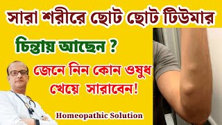 শরীরে ছোট ছোট টিউমার? কোন ওষুধে সারবে, জেনে নিন! Homeopathic Medicine for Tumor