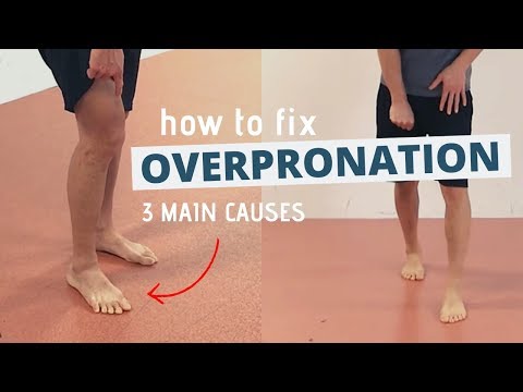 What causes a pronated foot?