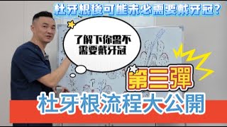 【牙科揭秘】杜完牙根之後，醫生點解強烈要求你做個牙冠？唔做有咩影響？蔡醫生解開其中的原因！【大灣區種牙 認準蔡文穎】#口腔健康 #北上睇牙 #種植牙 #博耀口腔#加拿大#多倫多