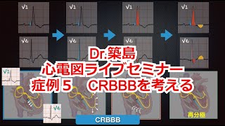 【心電図検定】築島先生の心電図検定対策ライブ　症例５　CRBBB（完全右脚ブロック）を考える！