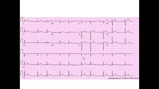 Stepwise Interpretation 9: Second Degree AV Block, Mobitz I (Wenckebach)