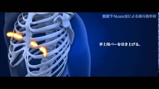 漏斗胸手術の動画(筋層下Nuss法による漏斗胸手術と従来Nuss法の比較)