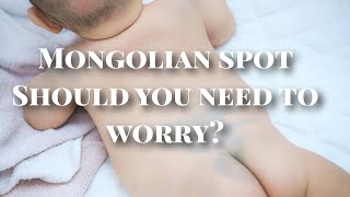 Mongolian spot| should you need to be worried ?