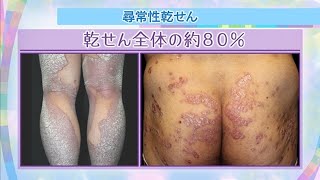 【NHK健康】免疫バランスの異常で起こる「乾せん」 2つのタイプや最新の治療法を解説