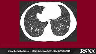 Approach to Pulmonary Hypertension: From CT to Clinical Diagnosis