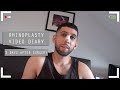 Rhinoplasty video diary - 2 days after surgery (3/15)