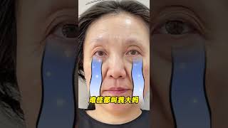 我去做了个无痕筋膜提升，没想到竟是这样的结果！