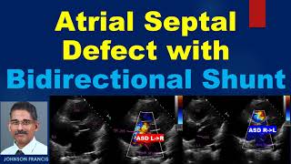 Atrial Septal Defect with Bidirectional Shunt