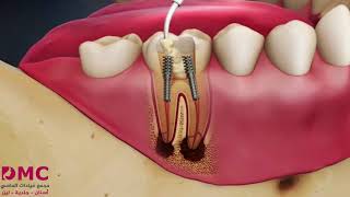 سحب العصب بجهاز الرتوري Rotary بجلسة لدى مجمع عيادات الماسي