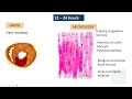 ischemic heart disease part 3 myocardial infarction gross u0026 microscopy