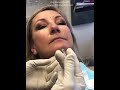 botox crows feet neck and frownlines