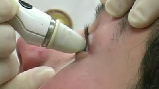 Measurement of Intraocular Pressure - Tono-Pen Technique