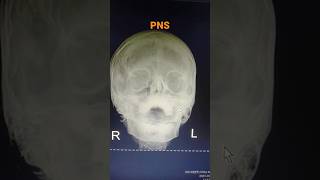 PNS Digital DR x-ray image #shorts #medical