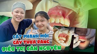 PHẪU THUẬT CẮT PHANH MÔI BÁM THẤP - NGUYÊN NHÂN GÂY THƯA RĂNG CỬA