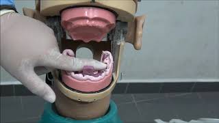 COMPLETE DENTURE: 2. Secondary Impression For Edentulous Arches