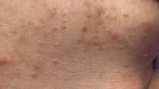 Relaxing Acne Treatment #118(Linh My Dang)P1