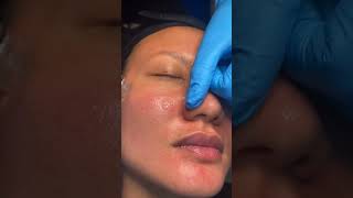 Hydrafacial for Acne! #celebrityskincare #hydrafacial