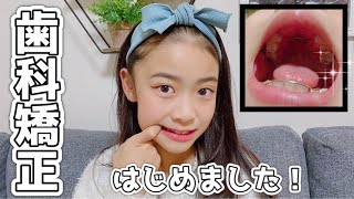 【歯科矯正】床矯正はじめました🦷               夜から朝の矯正ルーティン💕