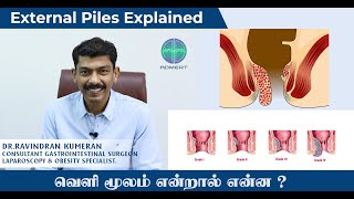 External Piles Explained | வெளி மூலம் என்றால் என்ன ? | Dr.Ravindran Kumeran | Tamil Medical Tips