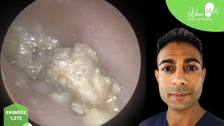 1,273 - Candida Fungal Ear Infection