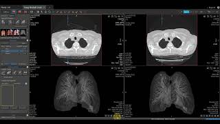 Vitrea Demonstrations  |  Lung Nodule Analaysis