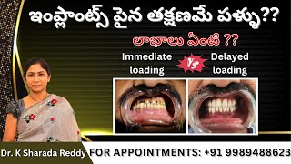 ఇంప్లాంట్స్ పైన తక్షణమే పళ్ళు?? Immediate loading VS Delayed loading | by Dr. K Sharada Reddy