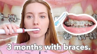 3 MONTHS WITH BRACES | My Entire Dental Hygiene Routine.