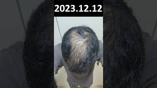 수술없이 머리카락 다시 생기는중 경험 노하우 모두 공개 예정 #30 20231212  I am getting my hair back without surgery