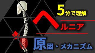 5分で理解できる椎間板ヘルニア原因とメカニズム【腰痛＃3】