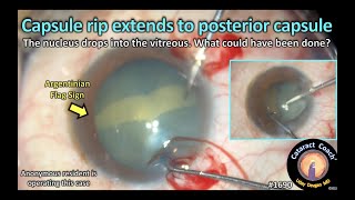 CataractCoach™ 1690: capsule rips extends to posterior capsule