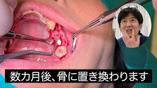 【ソケットリフト術】口腔外科専門医と学ぶ、新しい骨再生材料ボナークを使用したソケットリフト術 | 上顎骨が薄い症例のインプラント治療【５倍速解説】