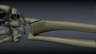 Surgical Treatment of Distal Radius Fractures