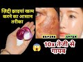 प्याज से झाइयां हटाने का कमाल का तरीका | Reduce Melasma, Pigmentation, Discolouration, Blackspots