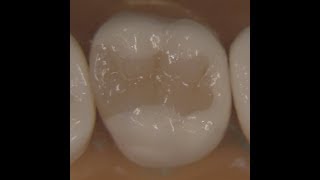 Class II Composite Restoration: The Quest for Morphological Replication