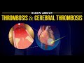 What is Thrombosis and Cerebral Thrombosis