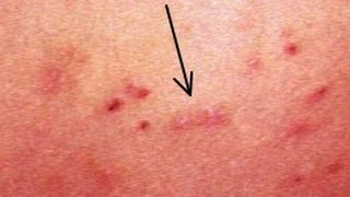 Escabiosis sarna humana imagenes