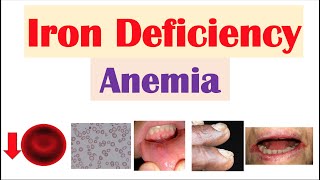 Iron-Deficiency Anemia (Overview) | Causes, Pathophysiology, Signs & Symptoms, Diagnosis, Treatment