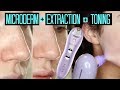 PORE VACUUM + Microdermabrasion | Michael Todd Total Refresher Review