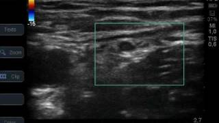 US Lateral circumflex femoral artery