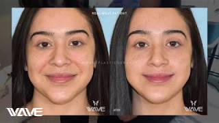 WAVE tells you how To Get RID of Smile Lines With Fillers The RIGHT WAY!