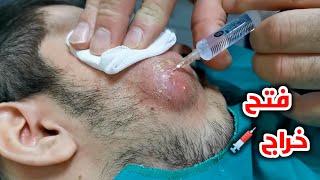 شاهد فتح خراج الاسنان خطوة بخطوة _ Dental abscess Incision and Drainage